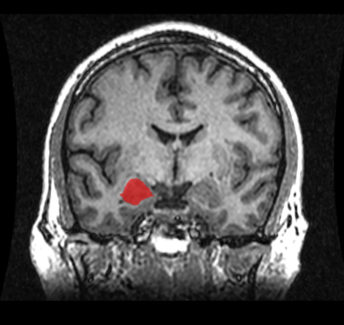 Coronal MRI of the human brain with the left amygdala highlighted in red — a small almond-shaped structure deep in the medial temporal lobe
