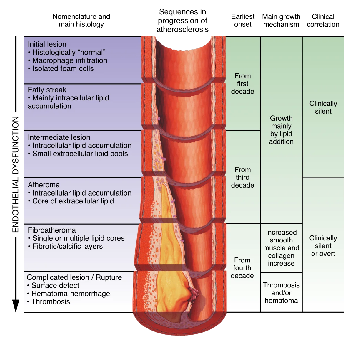 Cross-sectional illustration of an artery progressing through six stages of atherosclerosis: initial lesion with macrophage infiltration, fatty streak, intermediate lesion, atheroma, fibroatheroma, and complicated lesion or rupture, with annotations of typical age of onset and clinical presentation