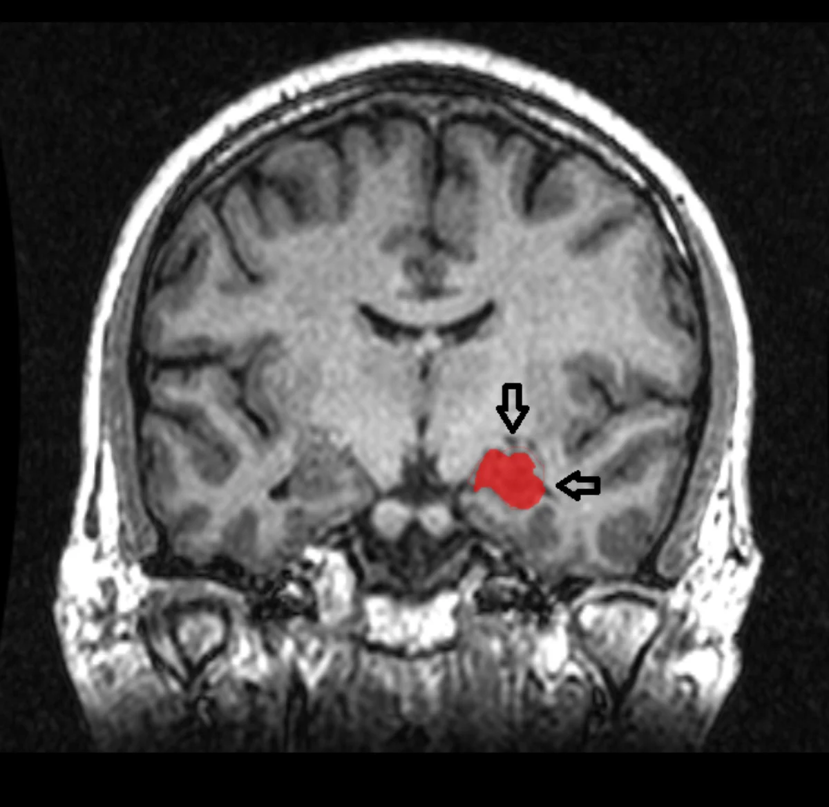 Coronal MRI of the human brain with the left hippocampus highlighted in red, indicated by two arrows — a curved structure in the medial temporal lobe