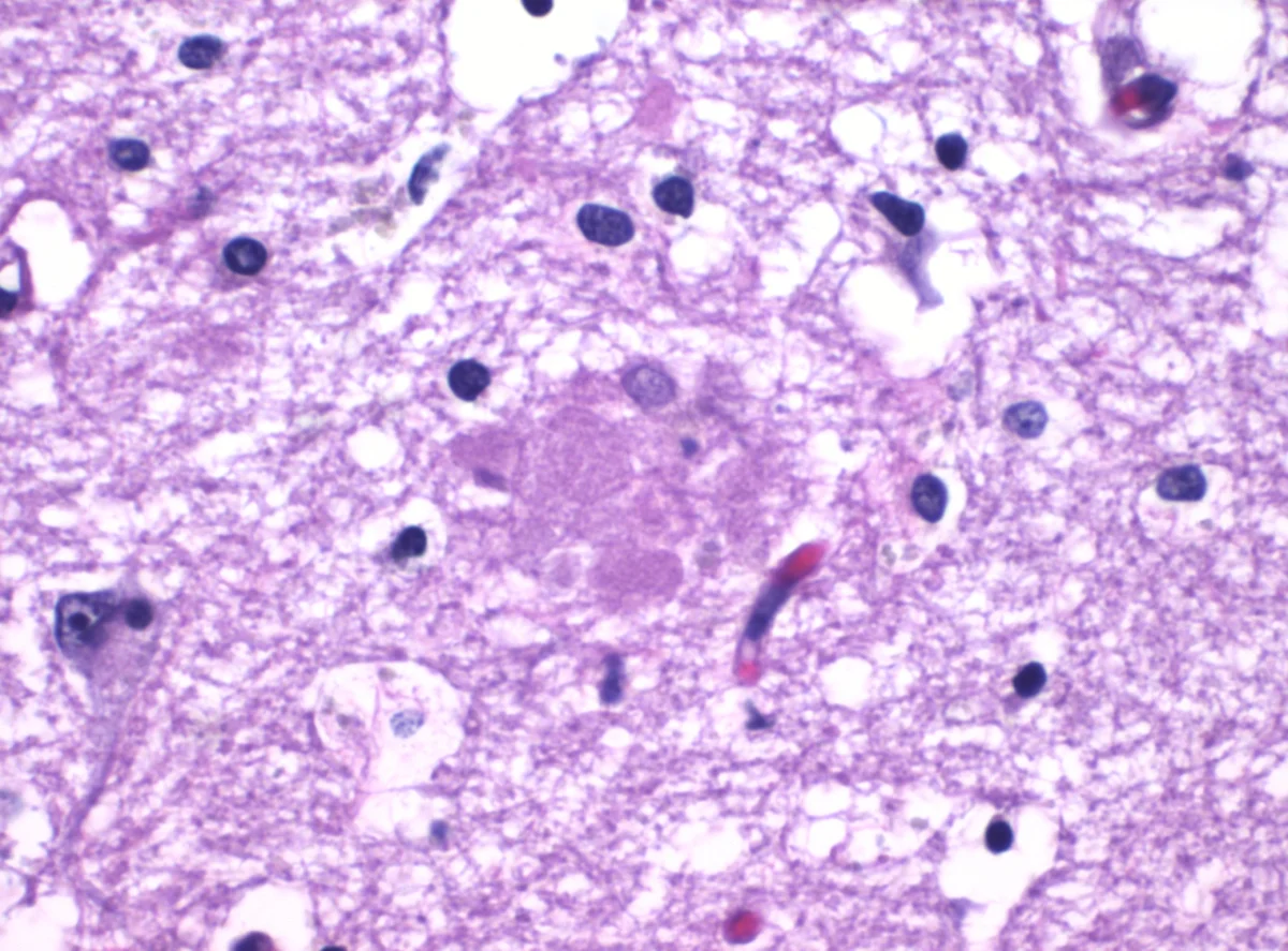 High-magnification histopathology slide of brain tissue showing a roughly circular dense brown amyloid plaque deposit surrounded by stained pink and purple neuropil — the classic extracellular β-amyloid aggregate seen in Alzheimer's disease