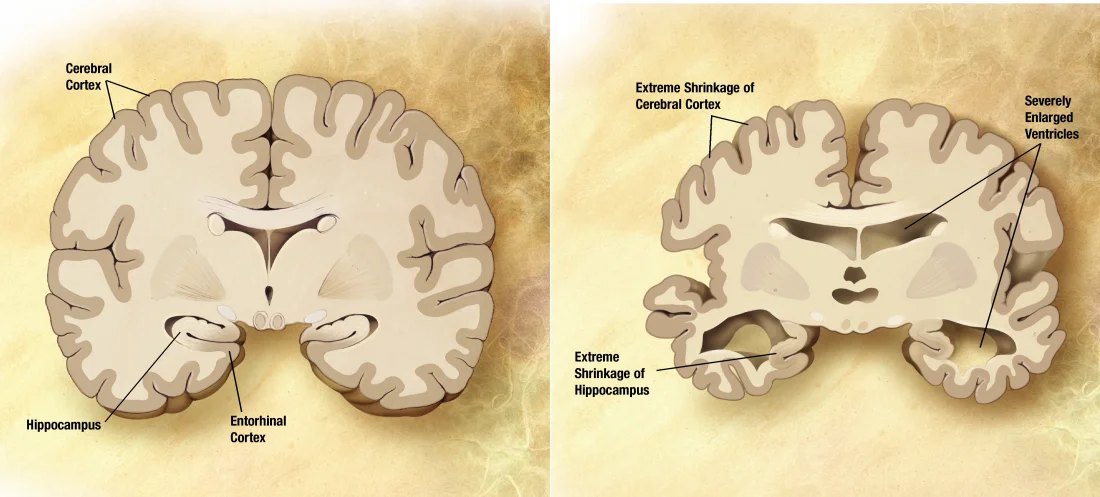 Two coronal cross-sections of a human brain shown side by side. The left section is a normal brain, with full cortical gyri labeled 'Cerebral Cortex,' a robust 'Hippocampus,' and labeled 'Entorhinal Cortex.' The right section is from a person with severe Alzheimer's disease, with labels indicating 'Extreme Shrinkage of Cerebral Cortex,' 'Extreme Shrinkage of Hippocampus,' and 'Severely Enlarged Ventricles' - the cortical sulci are wider, the gyri thinner, and the ventricles dramatically expanded