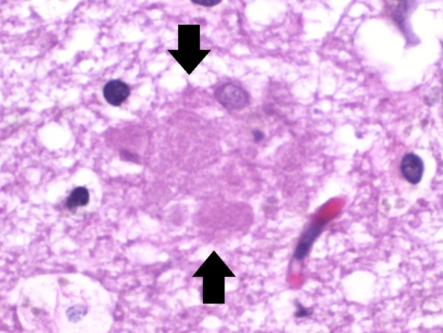 Histology micrograph of brain tissue stained pink and purple, with two black arrows pointing at a fuzzy, lighter-pink rounded mass in the center - an extracellular amyloid plaque - surrounded by smaller dark blue-purple cell nuclei