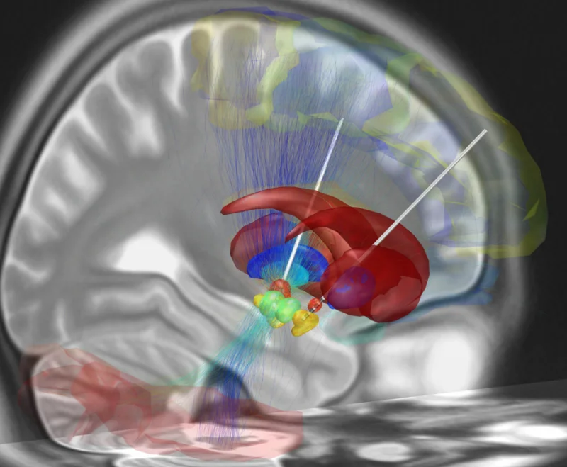3D MRI-based reconstruction of a brain in sagittal slice view, semi-transparent, with two thin white DBS electrode leads inserted from the top of the skull descending through the cortex and basal ganglia toward small color-coded clusters representing the subthalamic nucleus deep in the midbrain