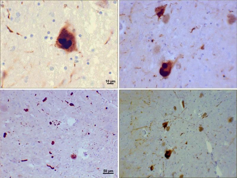 Four panels of immunohistochemistry stained brain tissue showing brown alpha-synuclein deposits inside surviving neurons. Two upper panels show round, dense Lewy bodies inside neuron cell bodies (one with a 10 micrometer scale bar). Two lower panels show thin thread-like Lewy neurites scattered through the surrounding neuropil (one with a 50 micrometer scale bar)