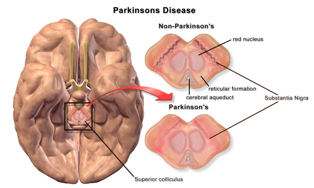 Anatomical illustration showing on the left a ventral view of a whole brain with a small dark box around the midbrain and a red arrow pointing to two enlarged midbrain cross-sections on the right. The top cross-section is labeled 'Non-Parkinson's' and shows two darkly pigmented Substantia Nigra bands clearly visible. The bottom section is labeled 'Parkinson's' and shows the same midbrain with the substantia nigra pigmentation almost completely faded - the dopamine-producing neurons have died