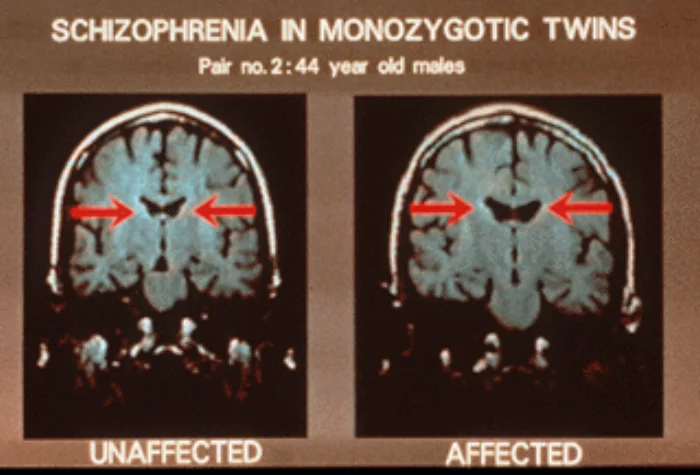 Two coronal MRI brain slices side by side from a pair of 44-year-old monozygotic twins, labeled UNAFFECTED on the left and AFFECTED on the right. Red arrows point to the lateral ventricles, which are visibly larger and darker in the affected twin compared to the unaffected twin