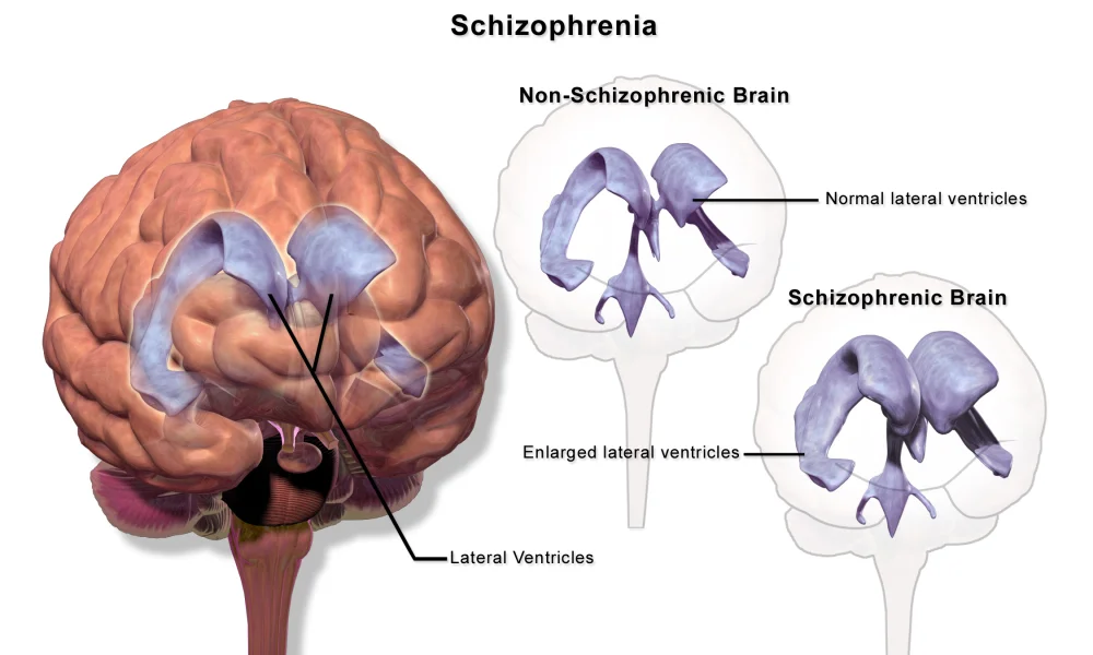 Medical illustration showing a 3D brain on the left with the lateral ventricles highlighted in blue, and on the right two ghosted brain outlines comparing the lateral ventricles in a non-schizophrenic versus a schizophrenic brain. The schizophrenic brain shows visibly enlarged lateral ventricles compared to the normal brain