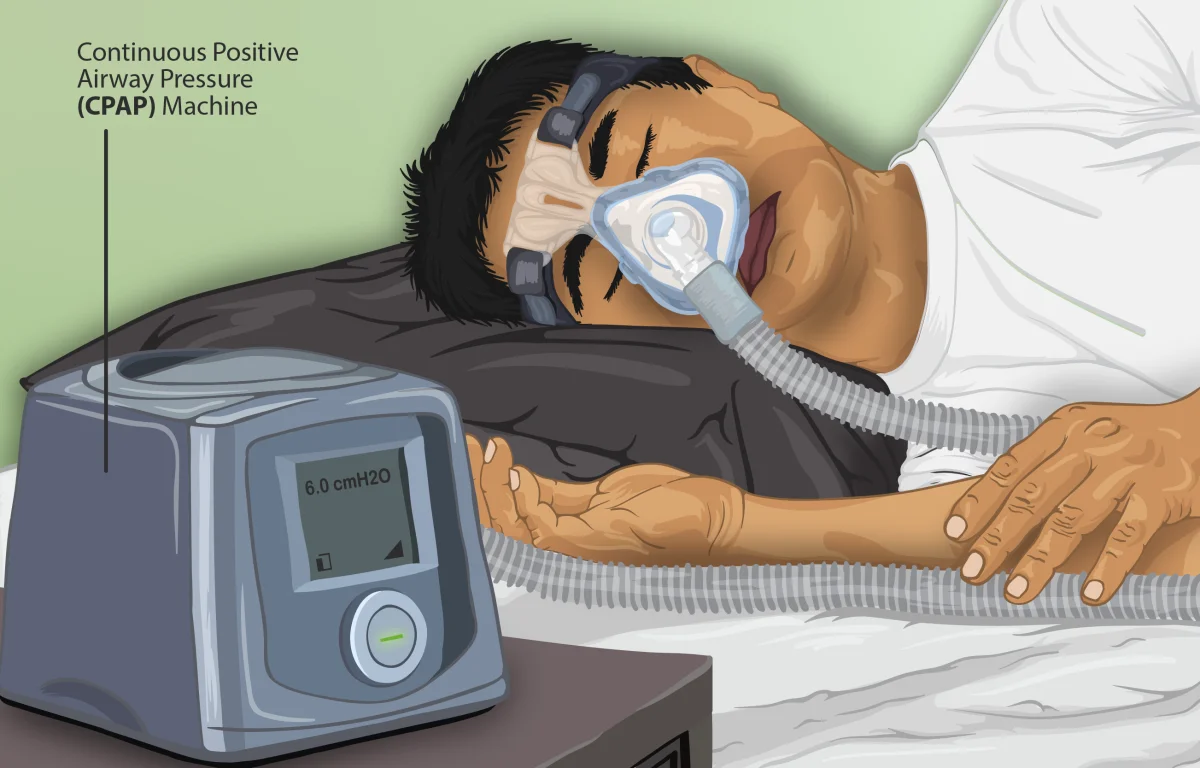 Illustration of a person sleeping on their side wearing a nasal CPAP mask connected by a flexible hose to a small bedside CPAP machine reading 6.0 cmH2O of pressure