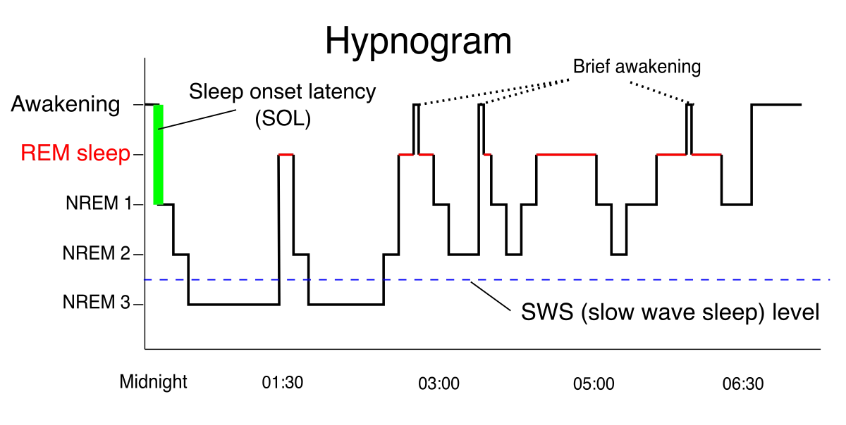 Hypnogram showing one night of sleep from midnight to about 7 AM, with the y-axis stepping through Awakening, REM, NREM 1, NREM 2, NREM 3 and a dashed slow-wave-sleep line. The trace dips deepest into NREM 3 in the first two cycles, then later cycles are dominated by longer red REM episodes with a few brief awakenings