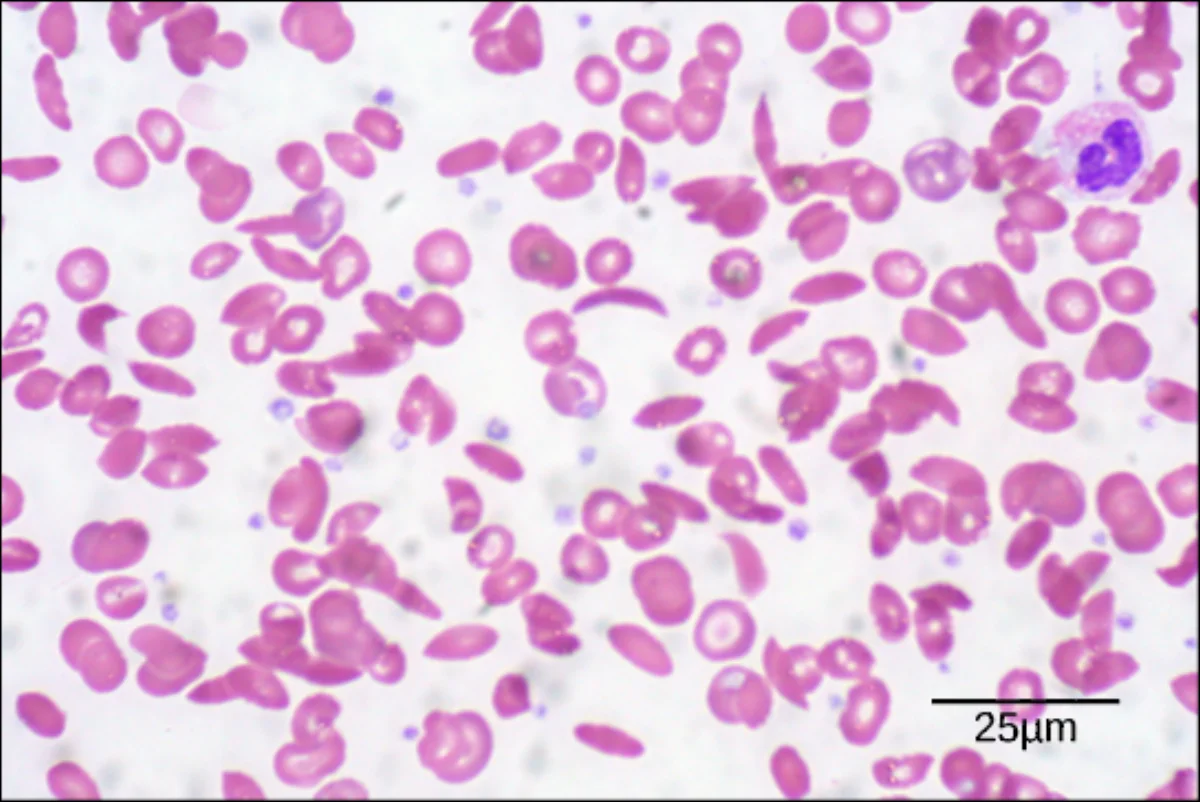 Scanning electron micrograph showing both normal disc-shaped red blood cells and sickled crescent-shaped red blood cells in a patient with sickle cell anemia