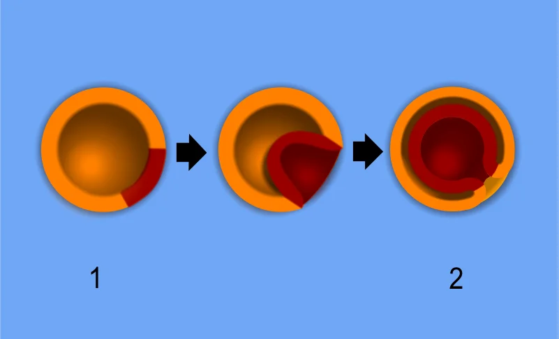 Diagram of gastrulation showing invagination of the blastula to form ectoderm, mesoderm, and endoderm germ layers