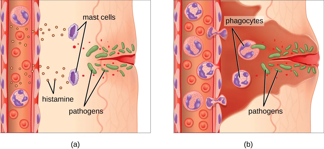 Diagram showing the inflammatory response: tissue damage triggers mast cell degranulation, histamine release causes vasodilation and increased permeability, neutrophils migrate via diapedesis to the infection site